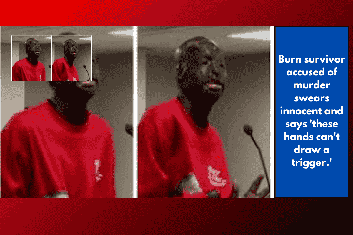 Burn survivor accused of murder swears innocent and says 'these hands can't draw a trigger.'