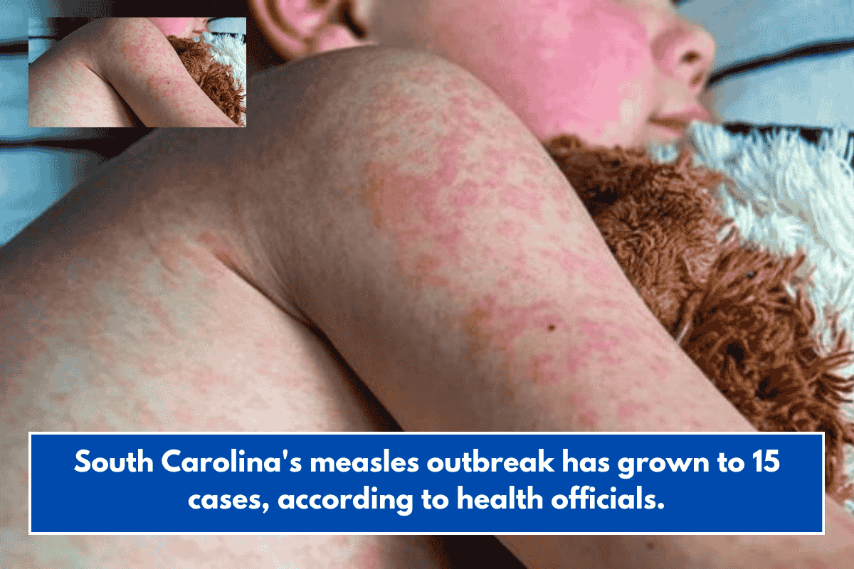 South Carolina's measles outbreak has grown to 15 cases, according to health officials.