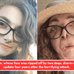 A woman, whose face was ripped off by two dogs, shares a candid update four years after the horrifying attack.